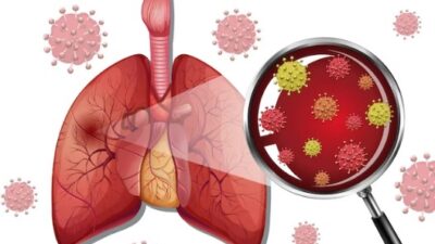 Apa Itu Pneumonia, Penyebabnya, dan Pengobatannya